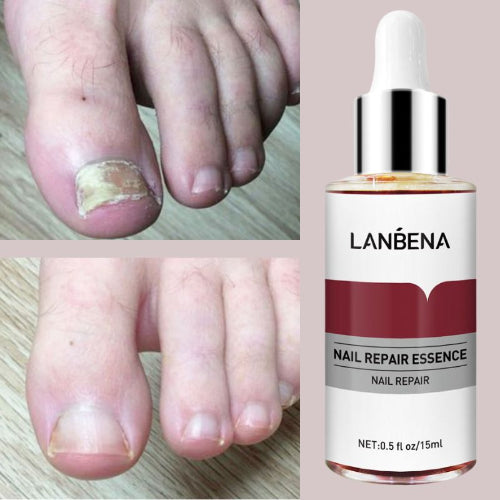 serum anti onychomycosis